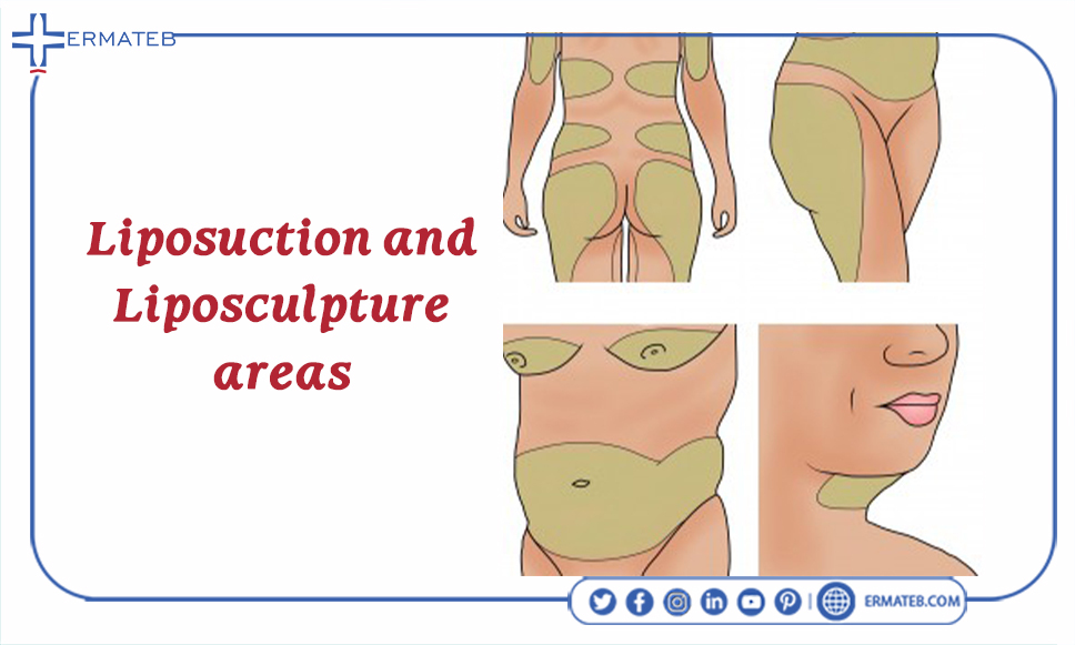 lipomatic and liposculpting areas